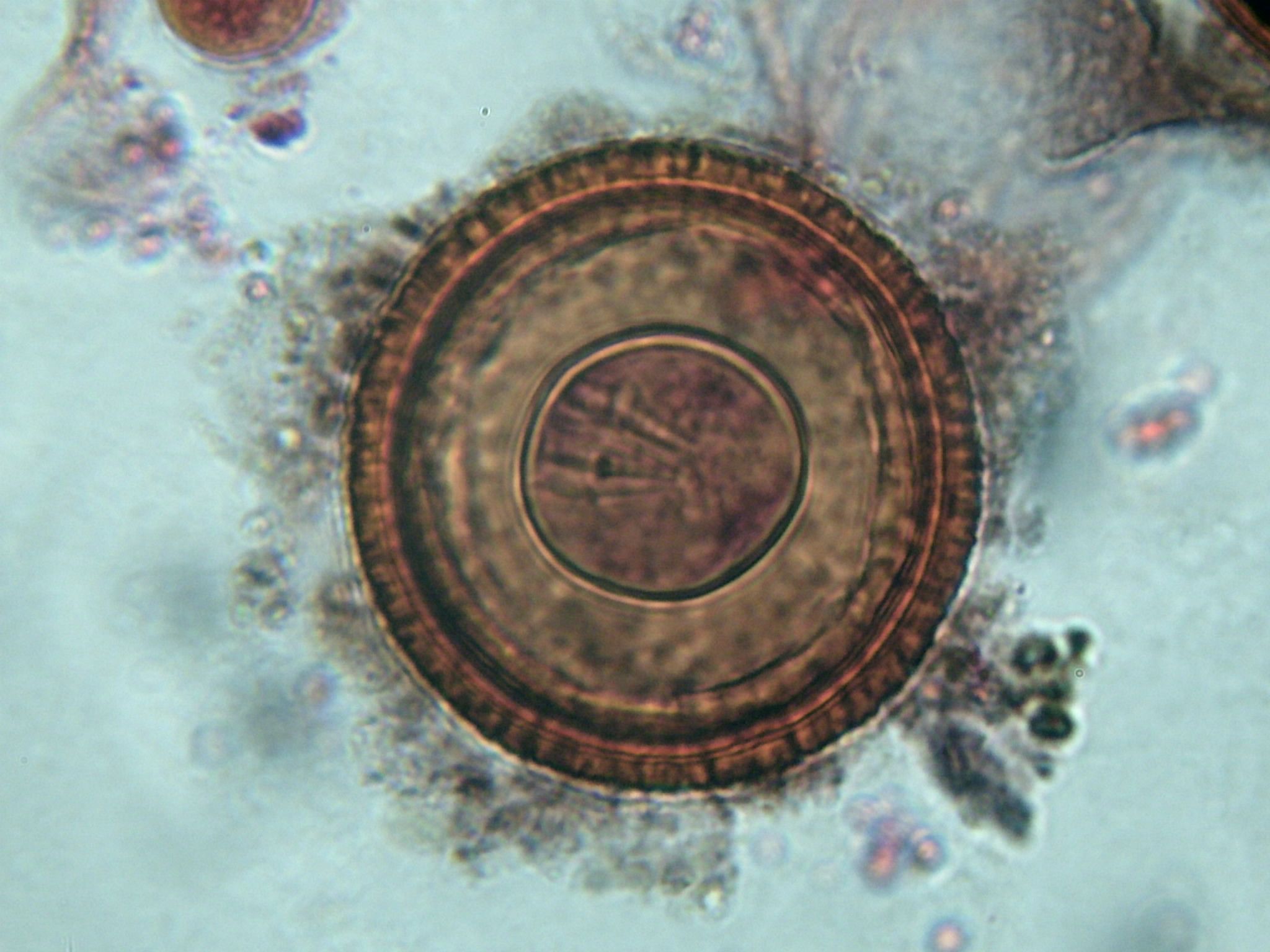 Os vermes podem viver em seu cérebro sem você saber (e aqui está como evitá